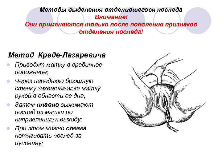 Методы выделения отделившегося последа Внимание! Они применяются только после появления признаков отделения последа! Метод