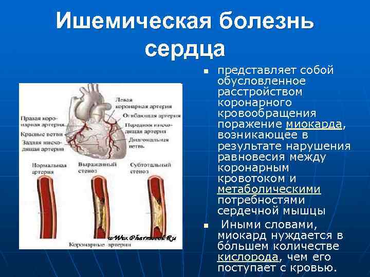 Ишемическая болезнь сердца n n представляет собой обусловленное расстройством коронарного кровообращения поражение миокарда, возникающее