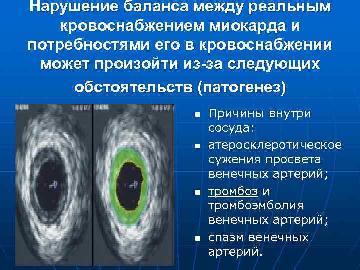 Нарушение баланса между реальным кровоснабжением миокарда и потребностями его в кровоснабжении может произойти из-за