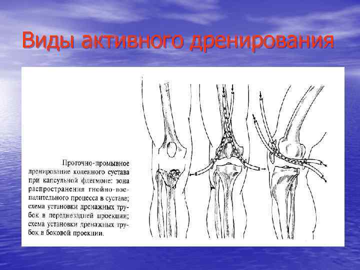 Виды активного дренирования 