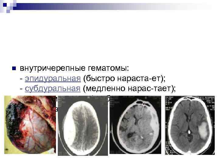  n внутричерепные гематомы: - эпидуральная (быстро нараста-ет); - субдуральная (медленно нарас-тает); - внутримозговая