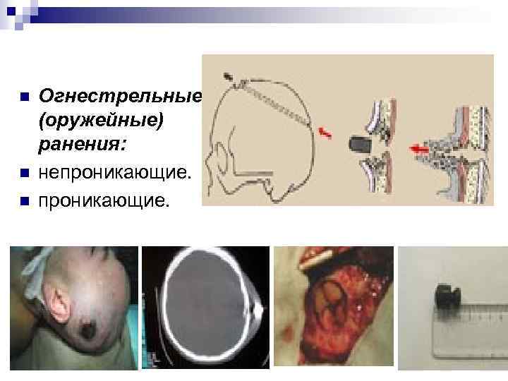  n n n Огнестрельные (оружейные) ранения: непроникающие. 