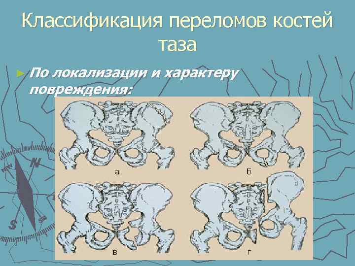 Переломы костей таза презентация травматология