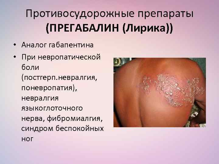 Противосудорожные препараты (ПРЕГАБАЛИН (Лирика)) • Аналог габапентина • При невропатической боли (постгерп. невралгия, поневропатия),