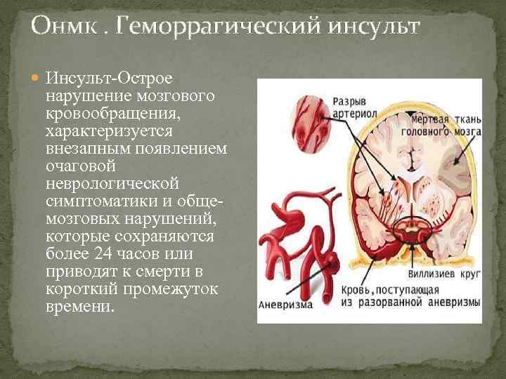 Онмк. Геморрагический инсульт Инсульт-Острое нарушение мозгового кровообращения, характеризуется внезапным появлением очаговой неврологической симптоматики и