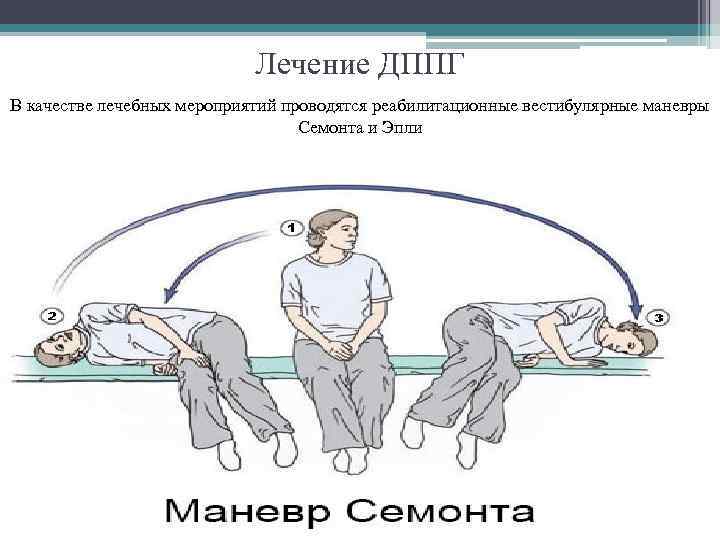 Лечение ДППГ В качестве лечебных мероприятий проводятся реабилитационные вестибулярные маневры Семонта и Эпли 