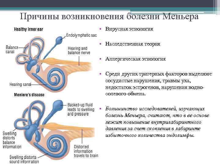 Причины возникновения болезни Меньера • Вирусная этиология • Наследственная теория • Аллергическая этиология •