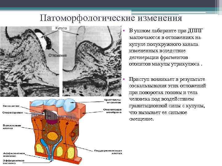 Патоморфологические изменения • В ушном лабиринте при ДППГ заключаются в отложениях на купуле полукружного
