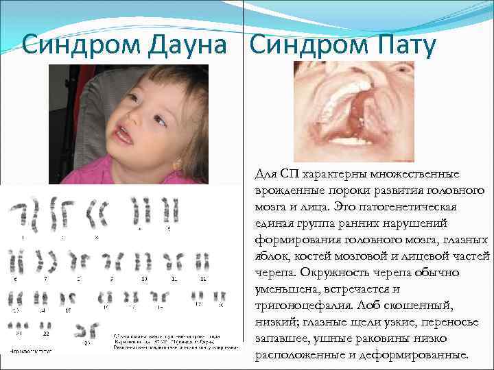 Синдром Дауна Синдром Пату Для СП характерны множественные врожденные пороки развития головного мозга и