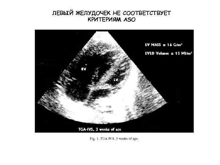 ЛЕВЫЙ ЖЕЛУДОЧЕК НЕ СООТВЕТСТВУЕТ КРИТЕРИЯМ ASO 