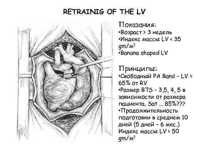 RETRAINIG OF THE LV Показания: • Возраст > 3 недель • Индекс массы LV