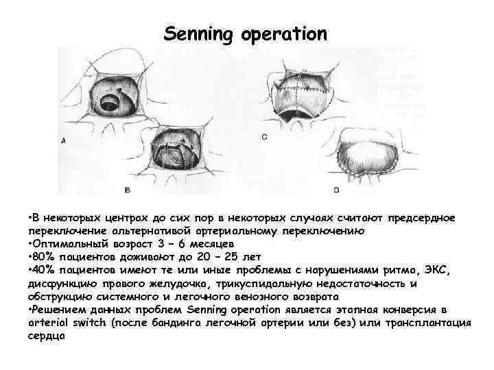 Senning operation • В некоторых центрах до сих пор в некоторых случаях считают предсердное