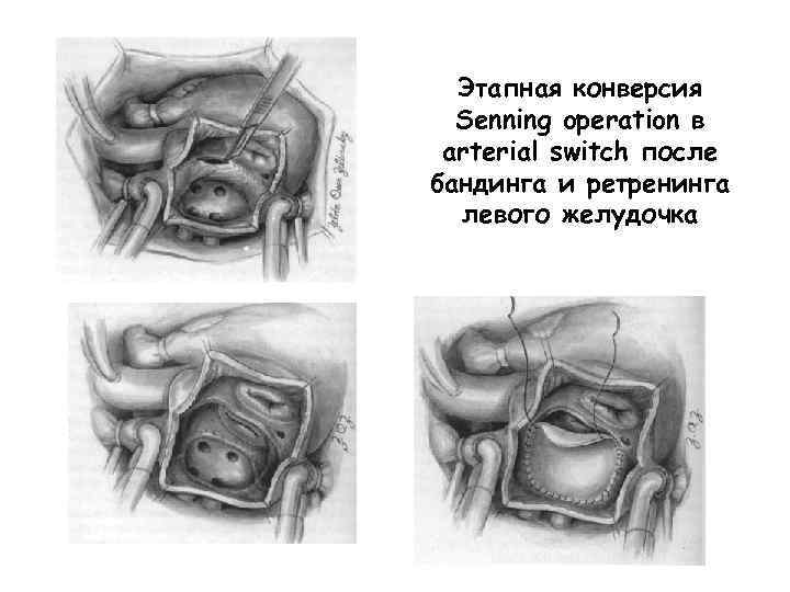 Этапная конверсия Senning operation в arterial switch после бандинга и ретренинга левого желудочка 