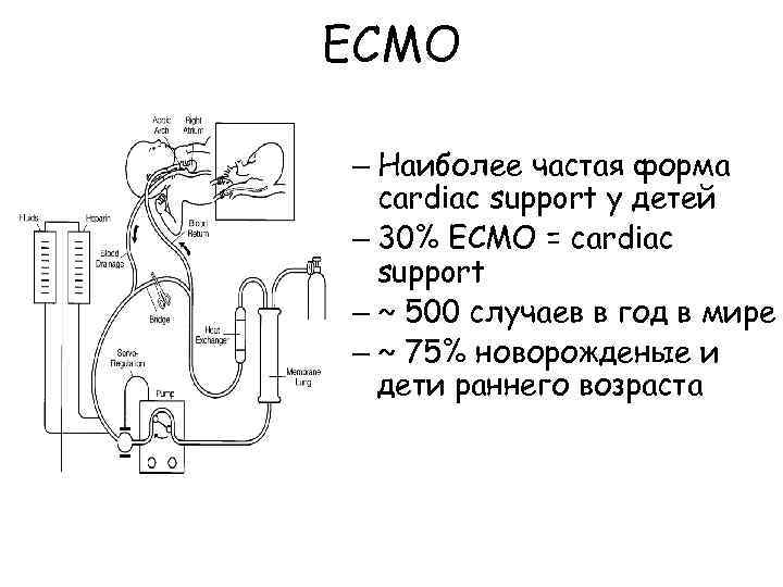 ECMO – Наиболее частая форма cardiac support у детей – 30% ECMO = cardiac