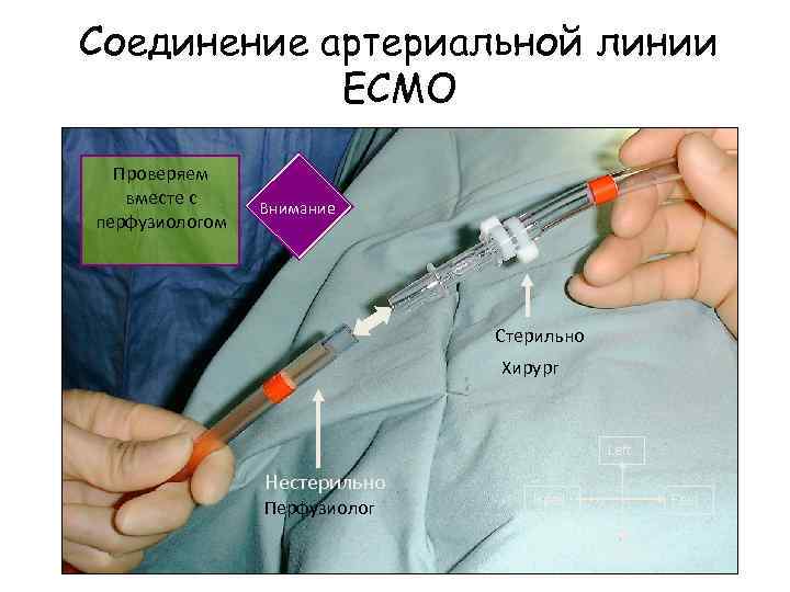 Соединение артериальной линии ECMO Проверяем вместе с перфузиологом Внимание Стерильно Хирург Left Нестерильно Перфузиолог