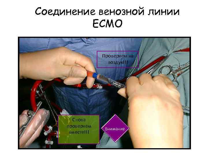 Соединение венозной линии ECMO Проверяем на воздух!!! Снова проверяем вместе!!! Внимание 