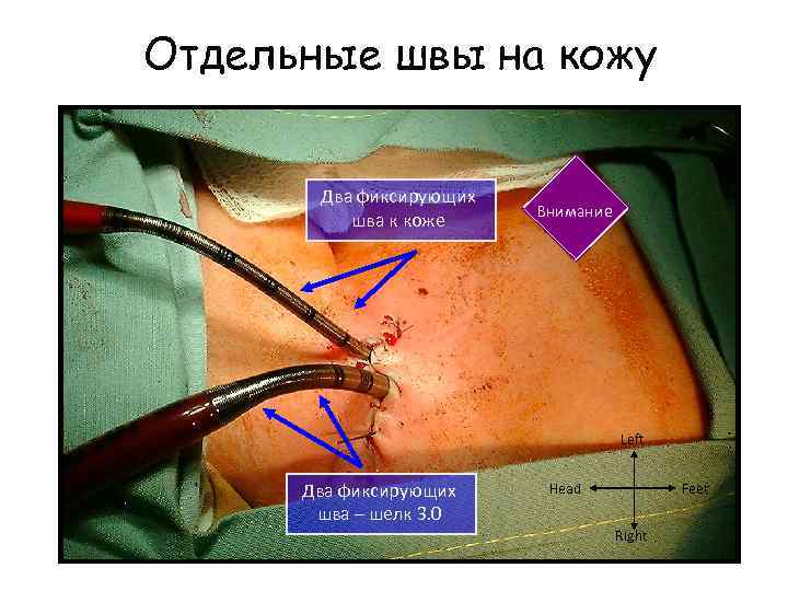 Отдельные швы на кожу Два фиксирующих шва к коже Внимание Left Два фиксирующих шва