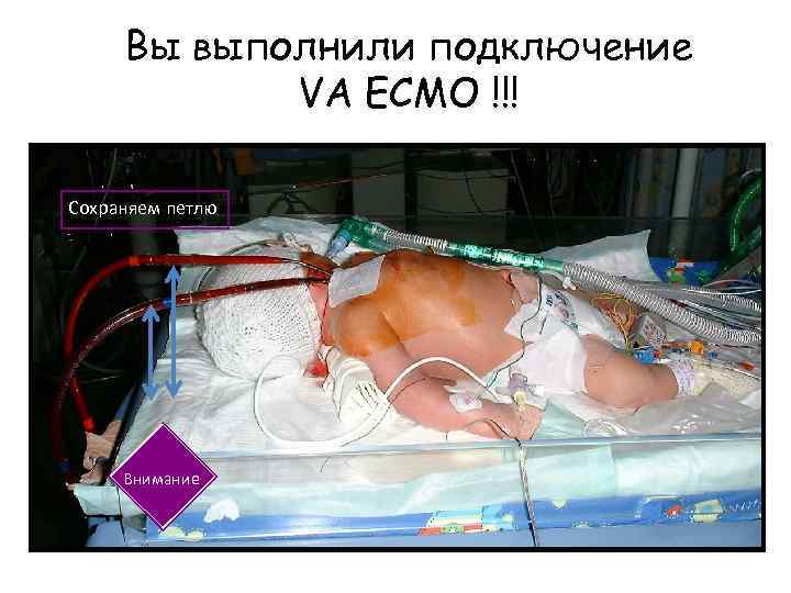 Вы выполнили подключение VA ECMO !!! Сохраняем петлю Внимание 