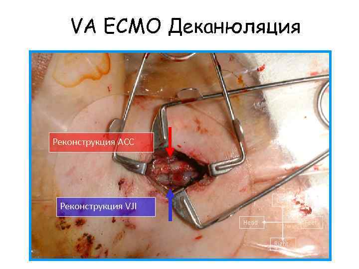 VA ECMO Деканюляция Реконструкция ACC Left Реконструкция VJI Head Feet Right 