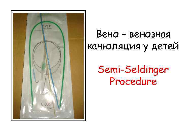 Вено – венозная канюляция у детей Semi-Seldinger Procedure 