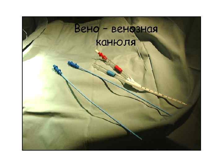 Вено – венозная канюля 