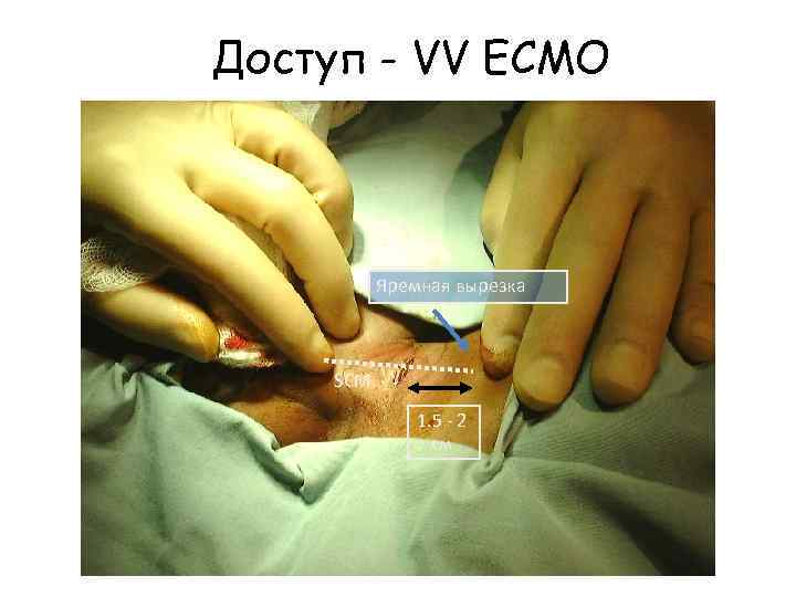 Доступ - VV ECMO Яремная вырезка SCM 1. 5 - 2 см 