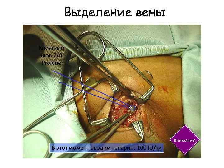 Выделение вены Кисетный шов 7/0 Prolene Внимание В этот момент вводим гепарин: 100 IU/kg