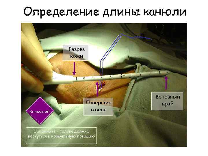 Определение длины канюли Разрез кожи Внимание Отверстие в вене Запомните – голова должна вернуться