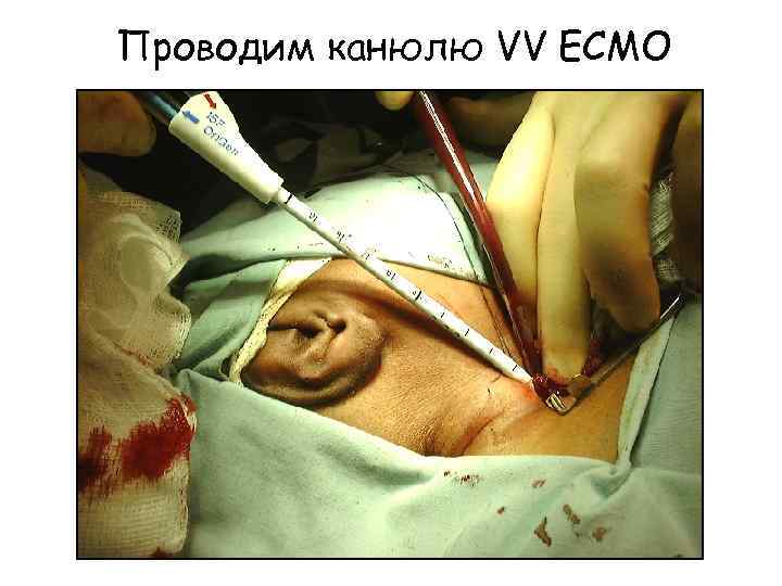 Проводим канюлю VV ECMO 