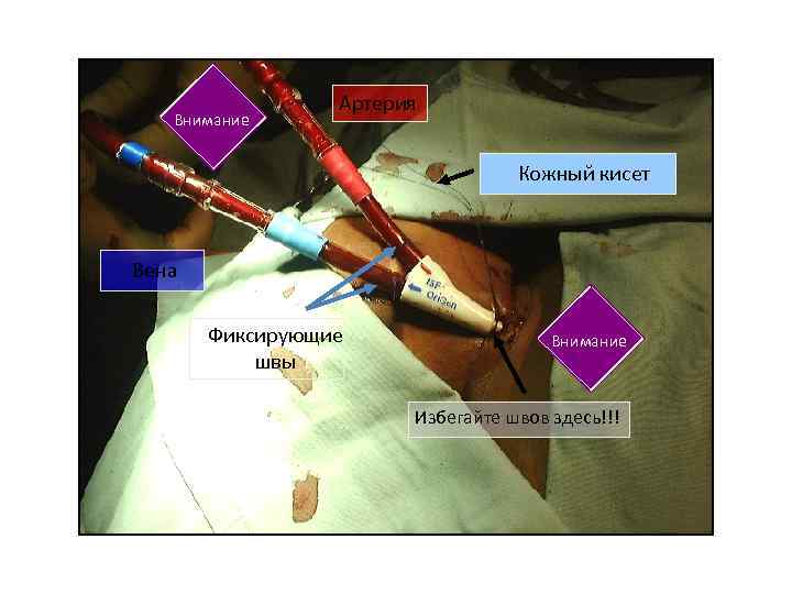 Внимание Артерия Кожный кисет Вена Фиксирующие швы Внимание Избегайте швов здесь!!! 