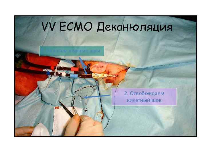 VV ECMO Деканюляция 1. Удаляем кожные швы 2. Освобождаем кисетный шов 