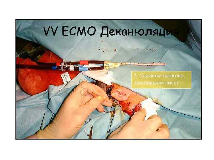 VV ECMO Деканюляция 3. Удаляем канюлю, завязываем кисет 