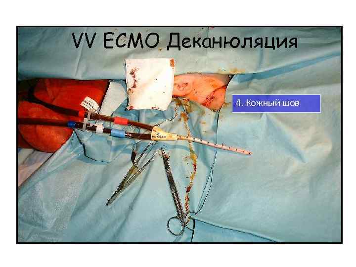 VV ECMO Деканюляция 4. Кожный шов 