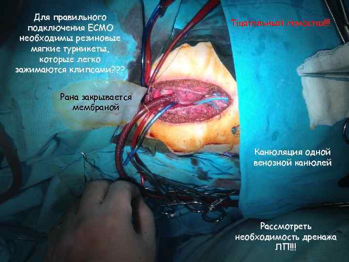 Для правильного подключения ECMO необходимы резиновые мягкие турникеты, которые легко зажимаются клипсами? ? ?