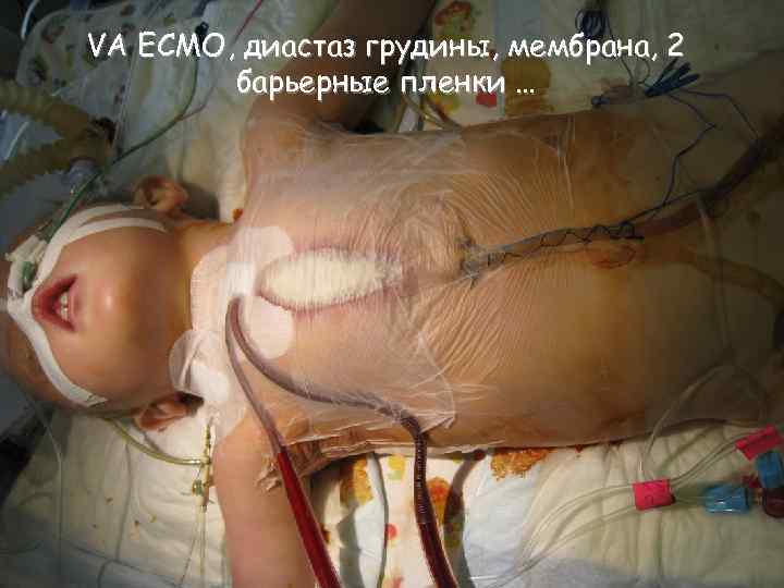 VA ECMO, диастаз грудины, мембрана, 2 барьерные пленки … 