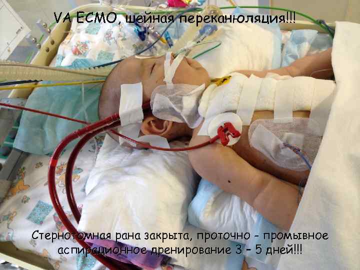 VA ECMO, шейная переканюляция!!! Стернотомная рана закрыта, проточно - промывное аспирационное дренирование 3 –