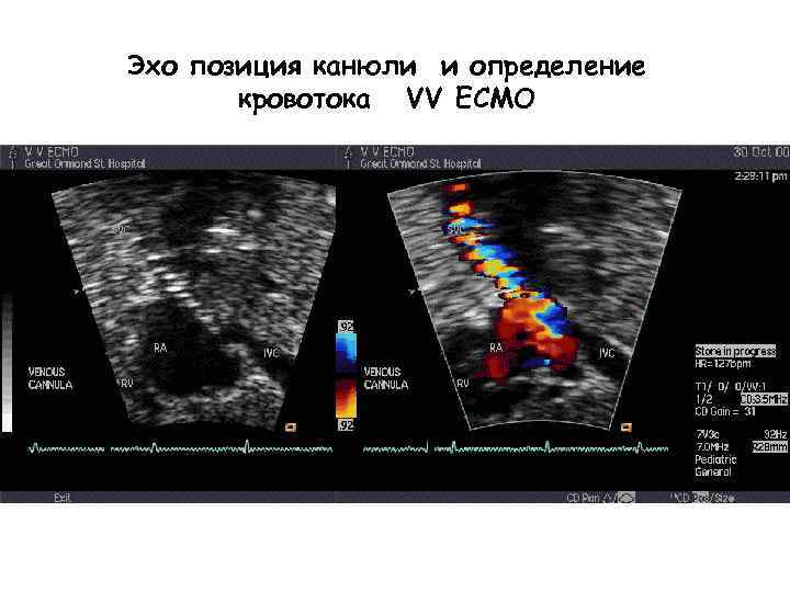 Эхо позиция канюли и определение кровотока VV ECMO 