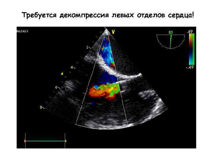 Требуется декомпрессия левых отделов сердца! 