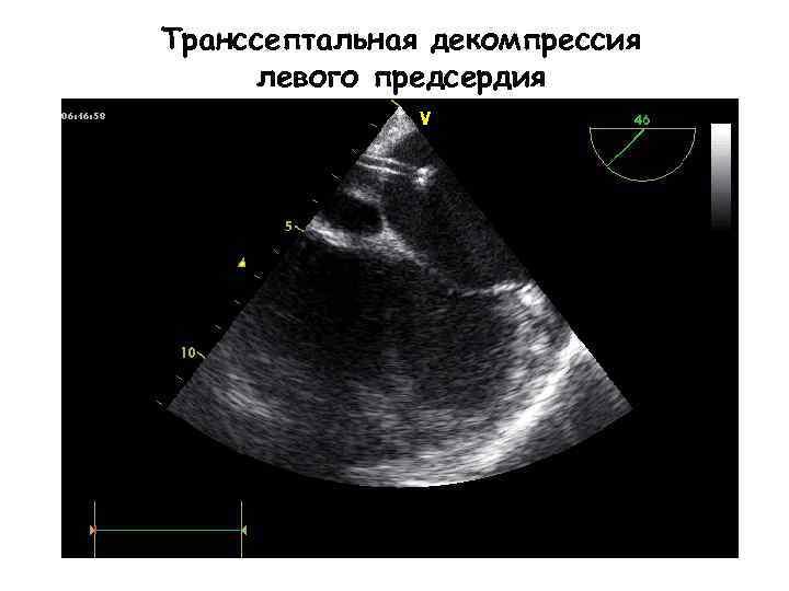 Транссептальная декомпрессия левого предсердия 