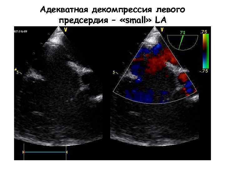 Адекватная декомпрессия левого предсердия – «small» LA 