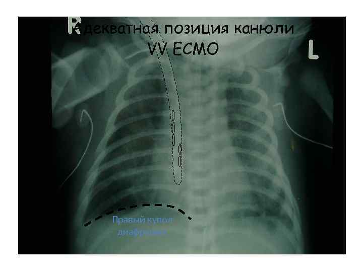 Адекватная позиция канюли VV ECMO Правый купол диафрагмы 