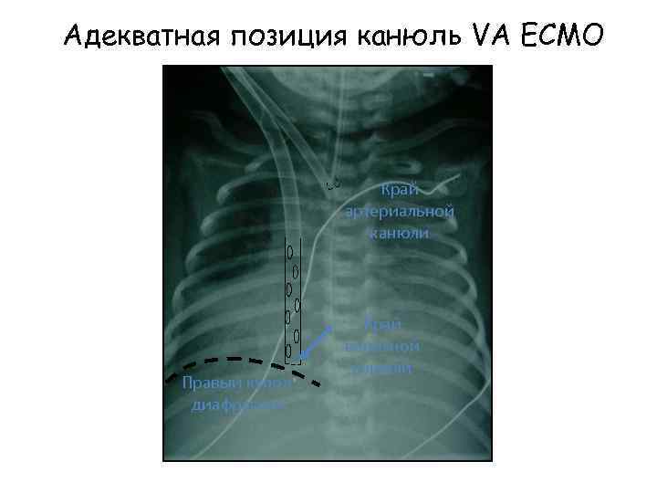 Адекватная позиция канюль VA ECMO Край артериальной канюли Правый купол диафрагмы Край венозной канюли