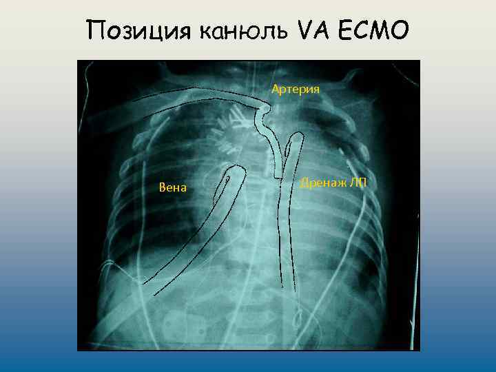 Позиция канюль VA ECMO Артерия Вена Дренаж ЛП 