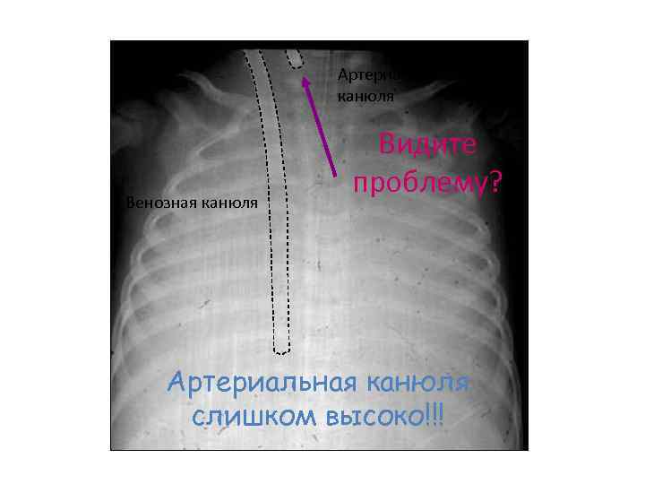 Артериальная канюля Венозная канюля Видите проблему? Артериальная канюля слишком высоко!!! 