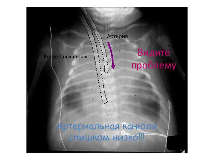 Артерия Венозная канюля Видите проблему Артериальная канюля слишком низко!!! 