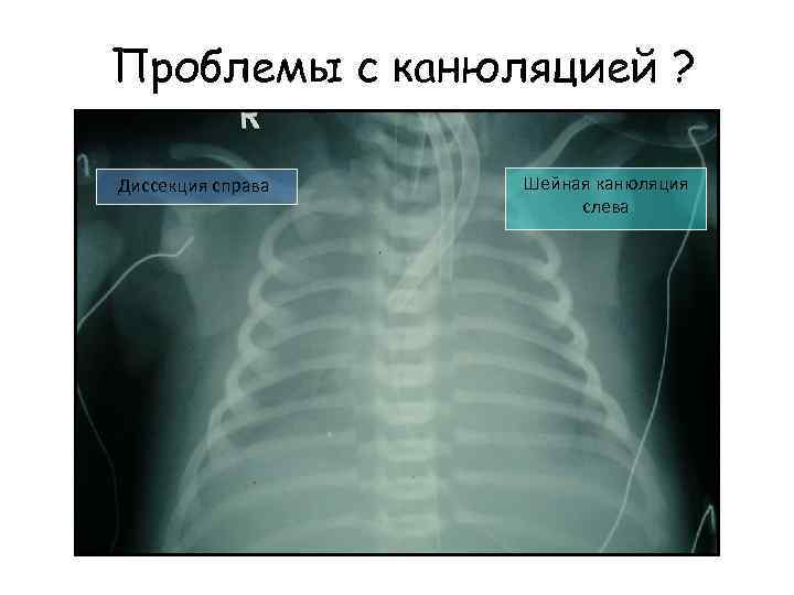 Проблемы с канюляцией ? Диссекция справа Шейная канюляция слева 