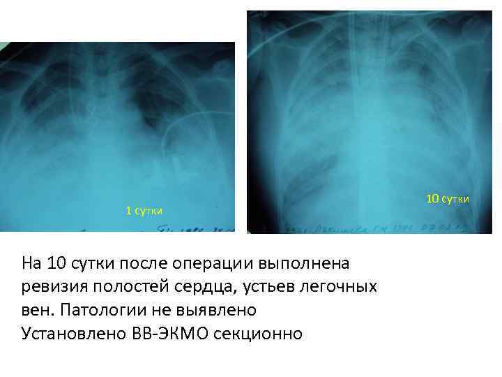 1 сутки На 10 сутки после операции выполнена ревизия полостей сердца, устьев легочных вен.