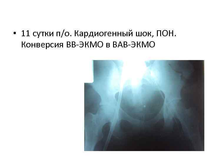  • 11 сутки п/о. Кардиогенный шок, ПОН. Конверсия ВВ-ЭКМО в ВАВ-ЭКМО 