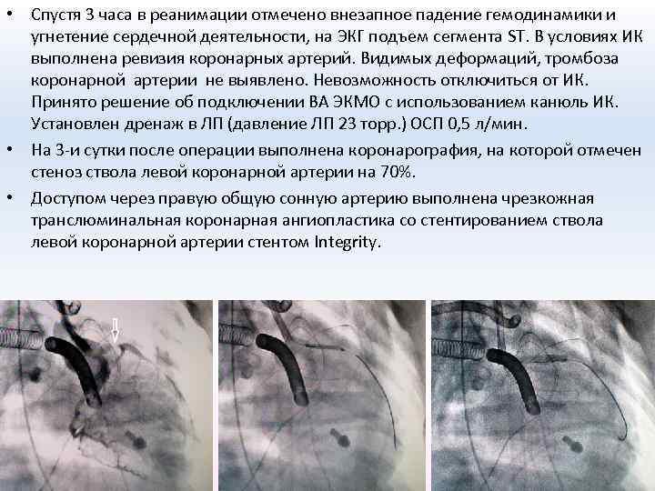 Левый ствол