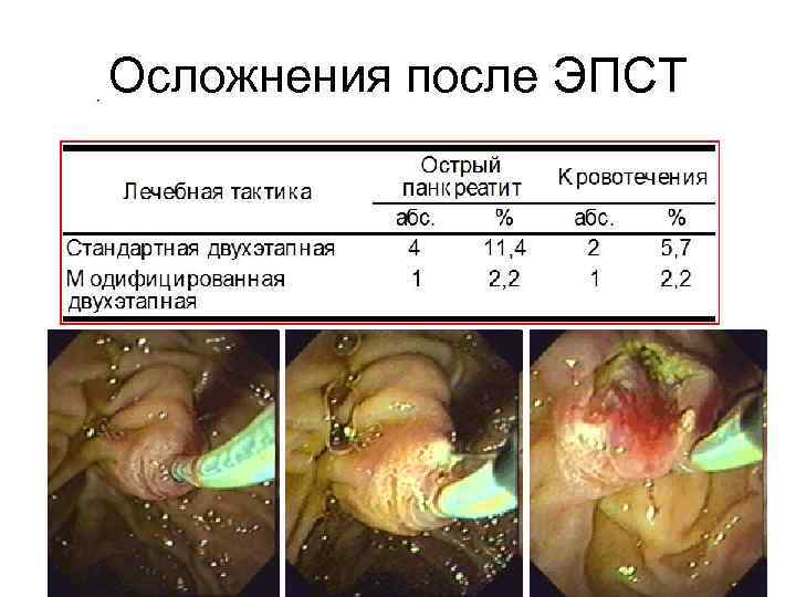Осложнения после ЭПСТ 